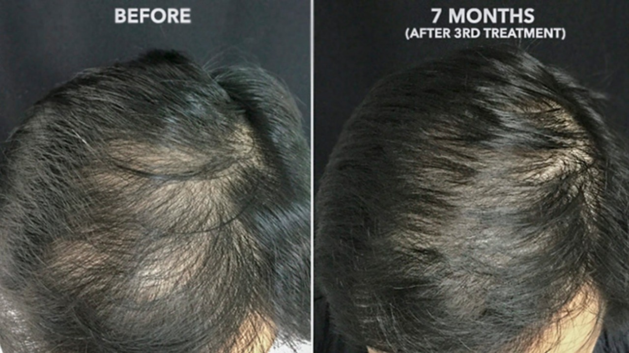 Beard & Hair Transplant London Specialists